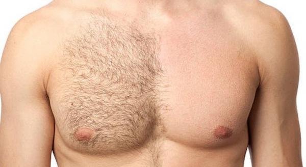 DEPILACIÓN MASCULINA 